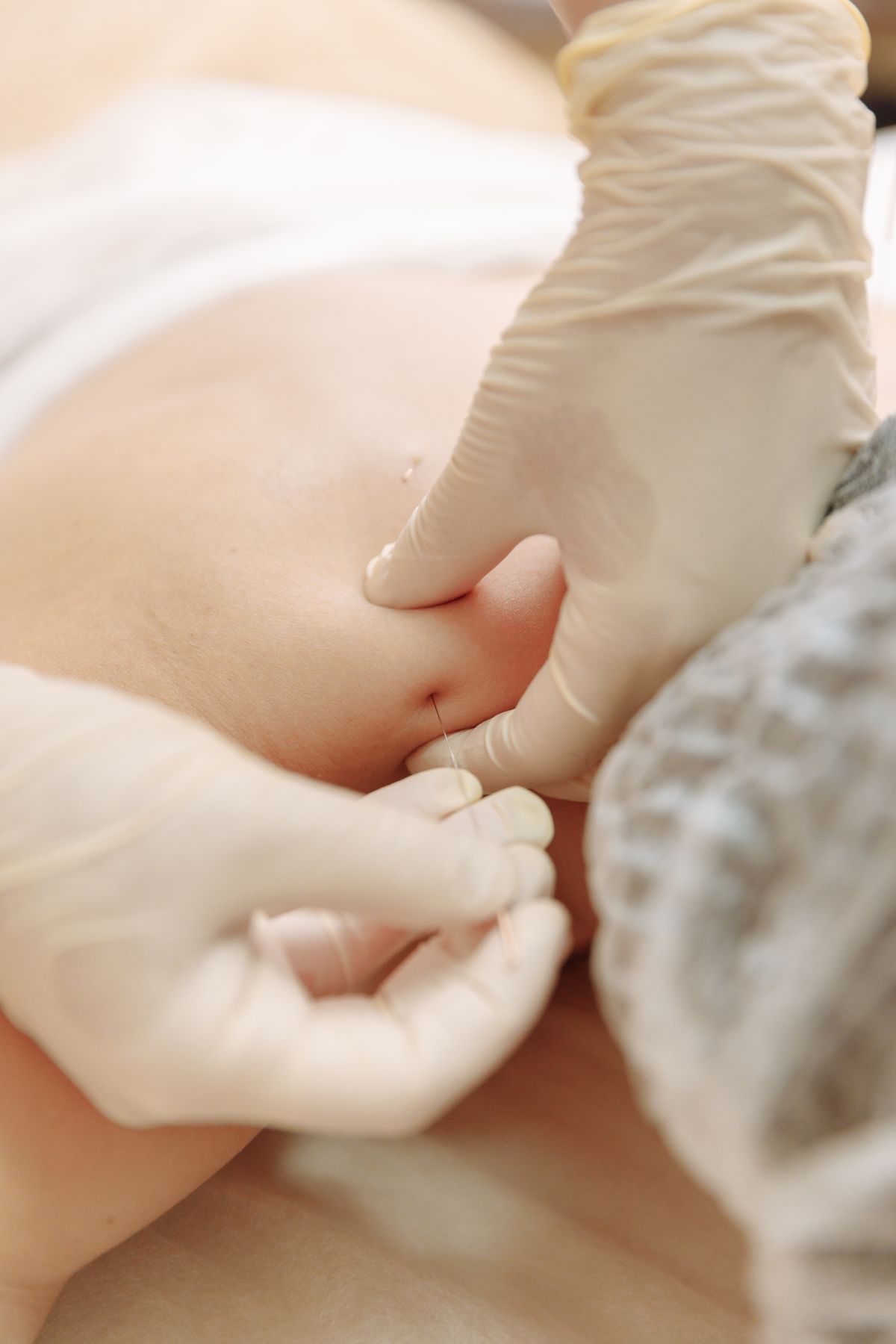 Dry needling treatment of the upper back muscles